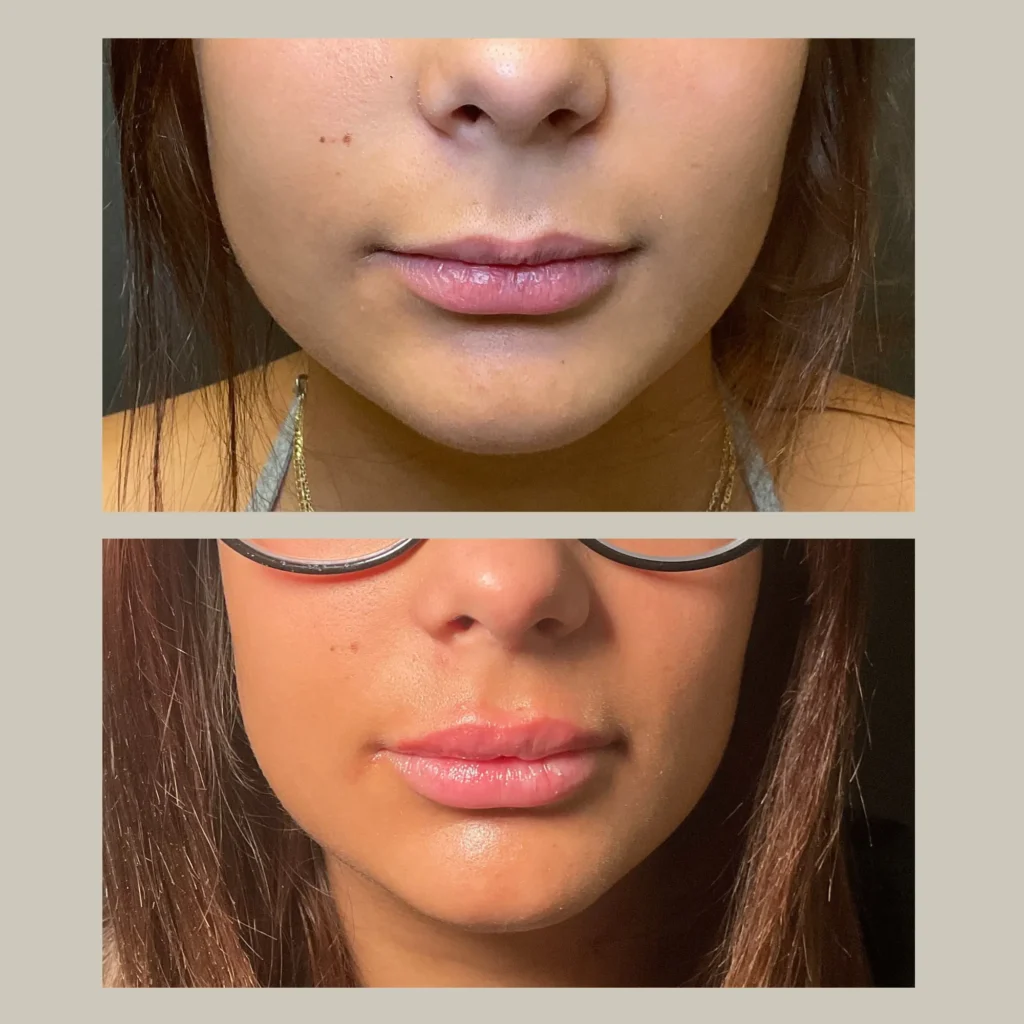 fillers before and after photo by forward healthy lifestyles in germantown wi