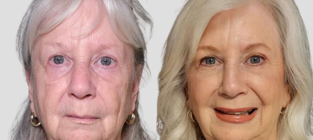 botox before and after results