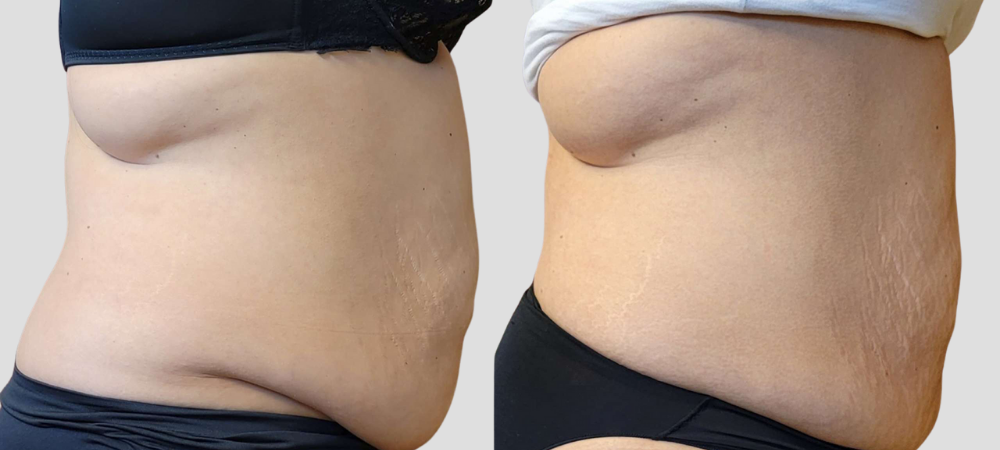 btl elixis ultra before and after results