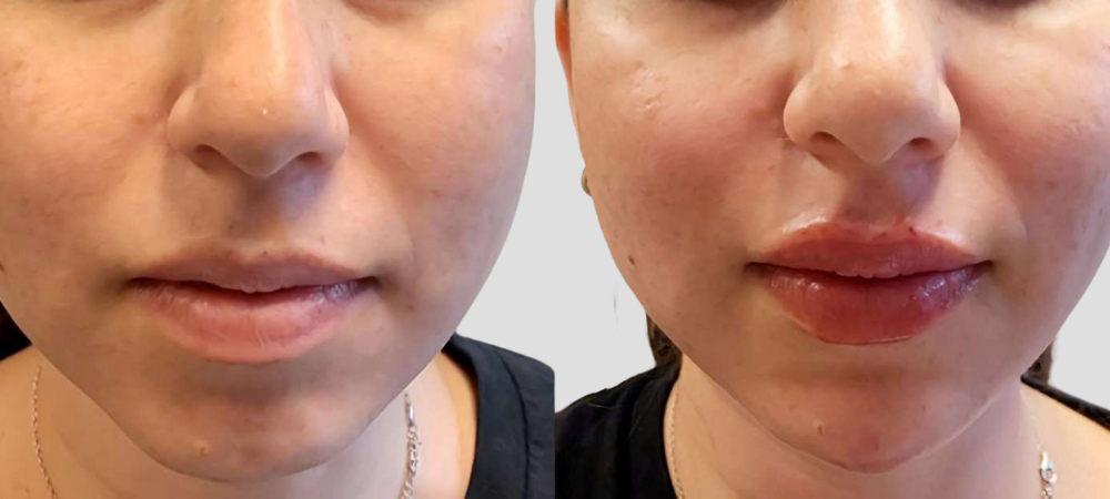 dermal fillers before and after results