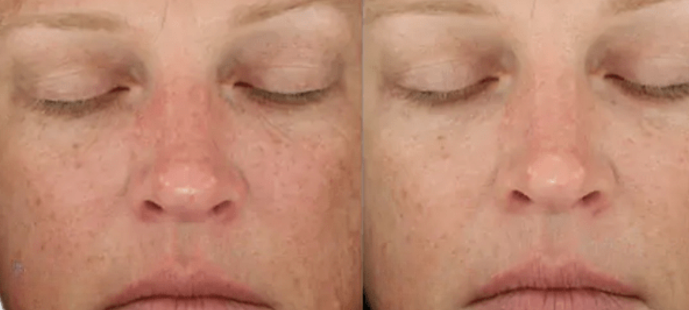 diamond glow before and after results