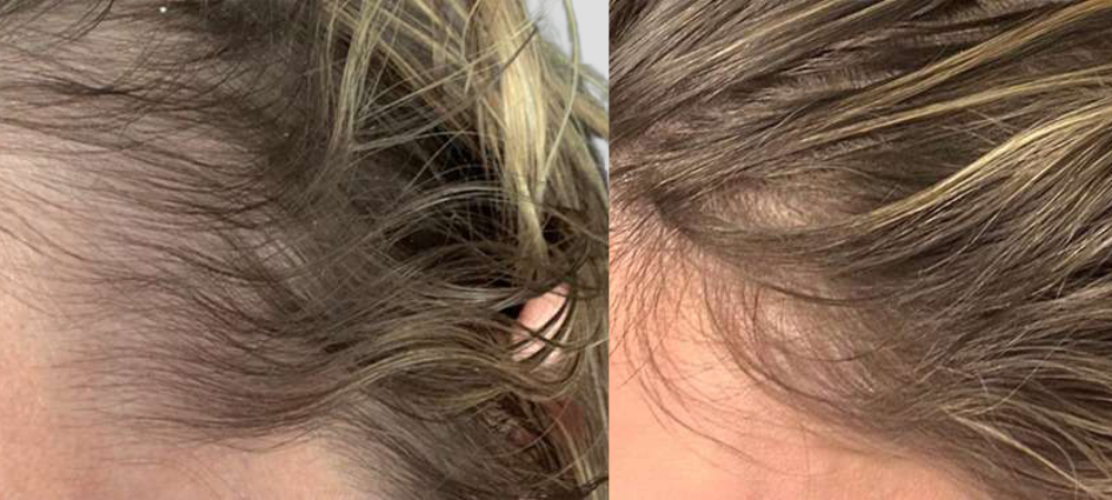 hair restoration before and after results