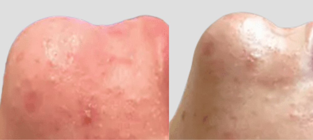 hydrafacial before and after results