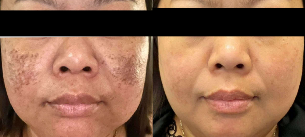 ipl laser before and after results