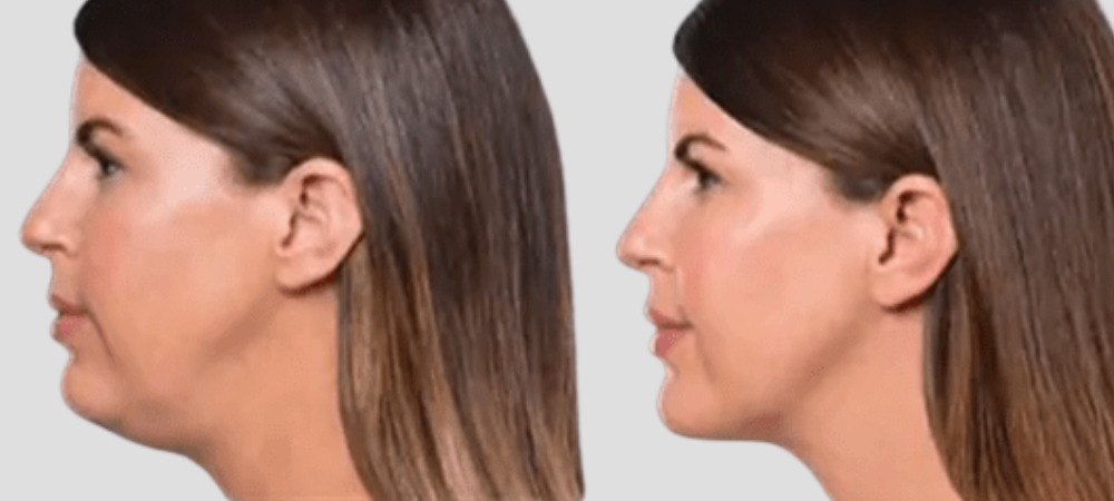 kybella before and after results