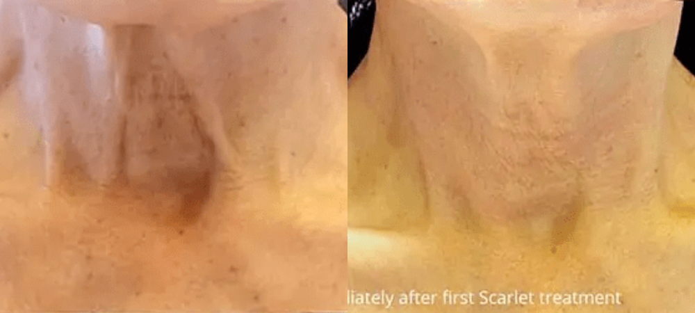 microneedling before and after results
