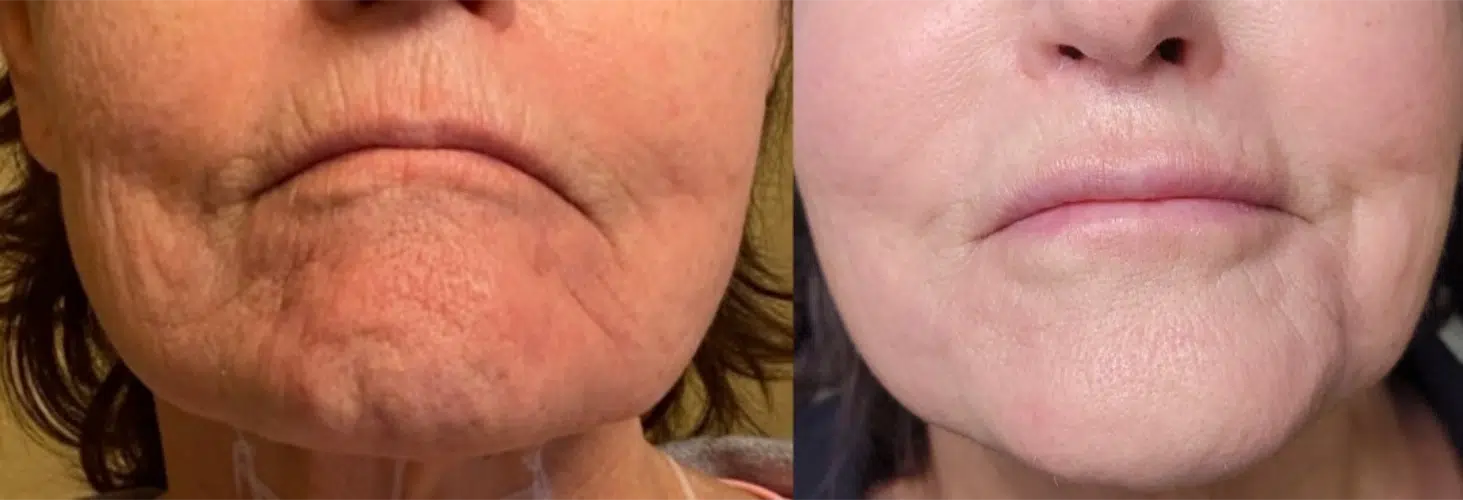 before and after botox before and after botox