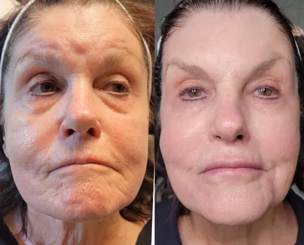 before and after botox before and after botox