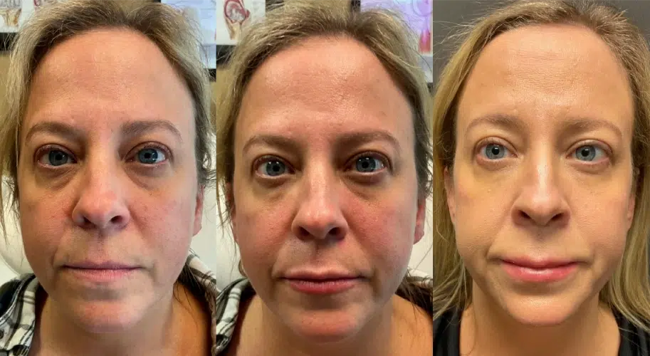 before and after botox before and after botox